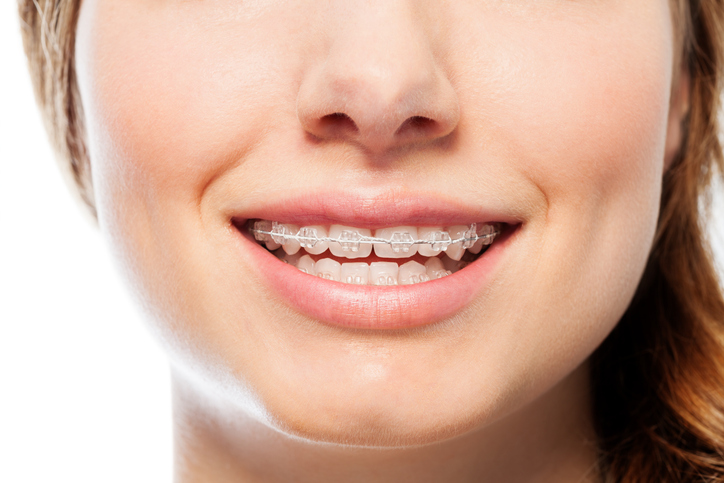 uśmiech kobiety z aparatem ortodontycznym 