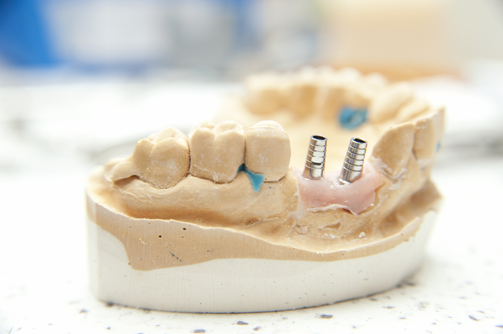 model implantu zębów