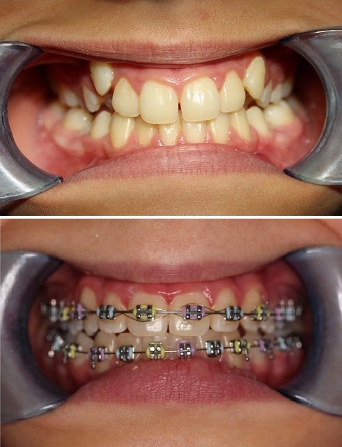 pierwszy etap leczenia ortodontycznego