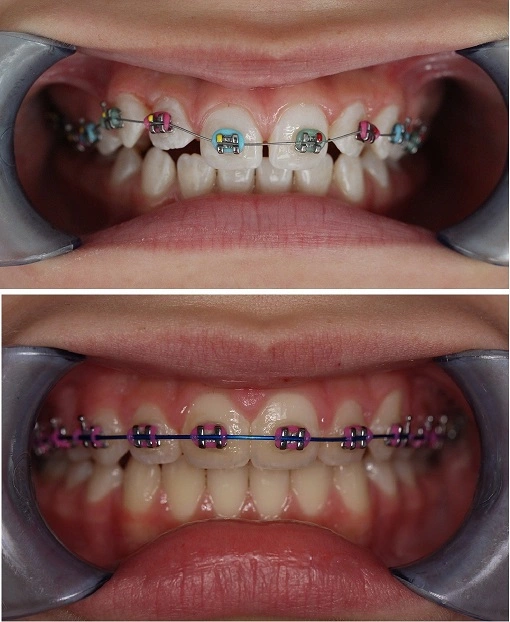 drugi etap leczenia ortodontycznego