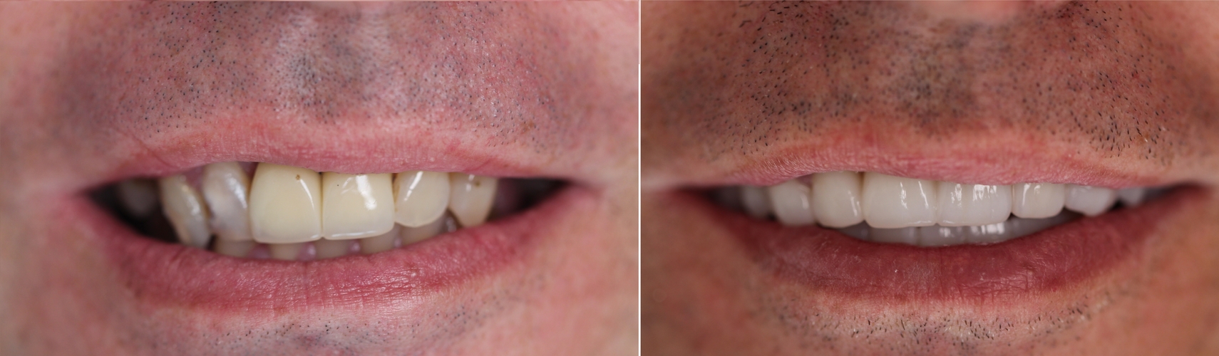 porównanie zębów przed i po