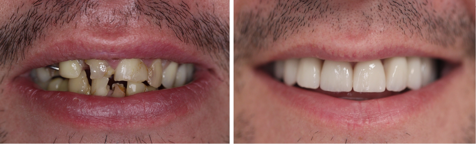 porównanie zębów przed i po